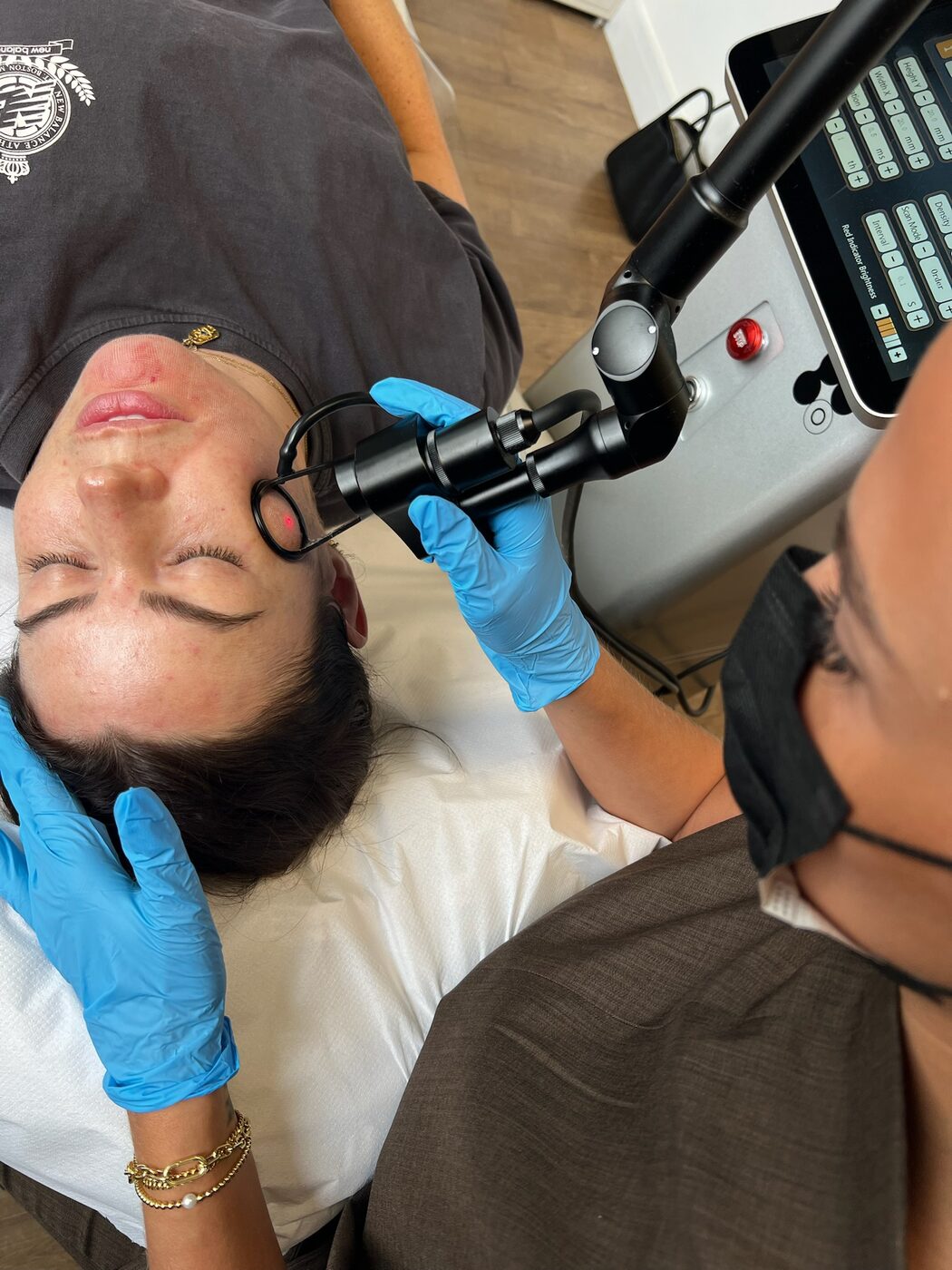 CO2 laser treatment on the face