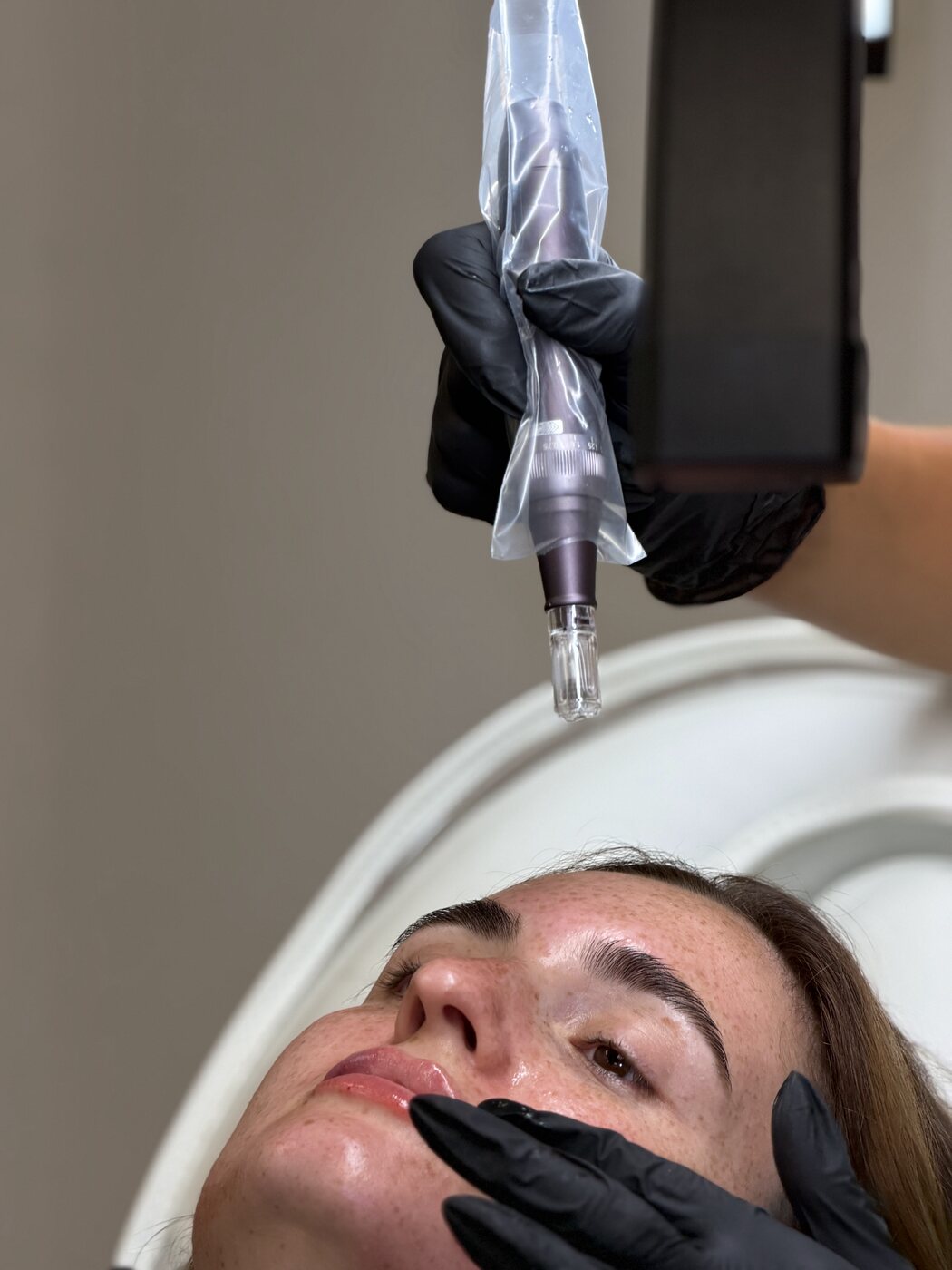 Micro-needling skin treatment at Jade Peel Aesthetics